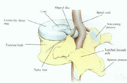 Disc Prolapse and nerve pinch