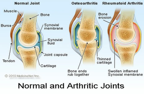 joint arthritis