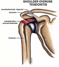 Shoulder Tendonitis