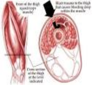 Intermuscular muscle contursion