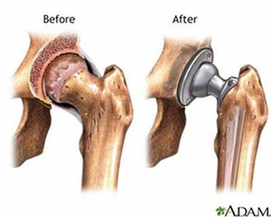 hip replacement