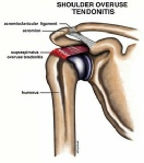 Shoulder Tendonitis