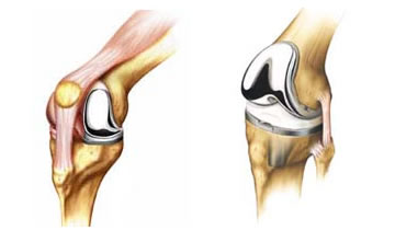 knee replacement