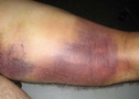 Muscle-bruising