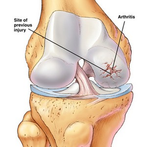 knee arthrosis
