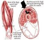 Intermuscular muscle contursion